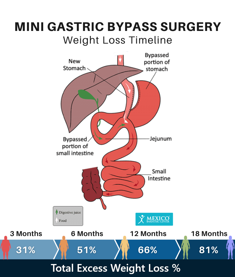 Weight Loss Surgery Procedure Growth Chart