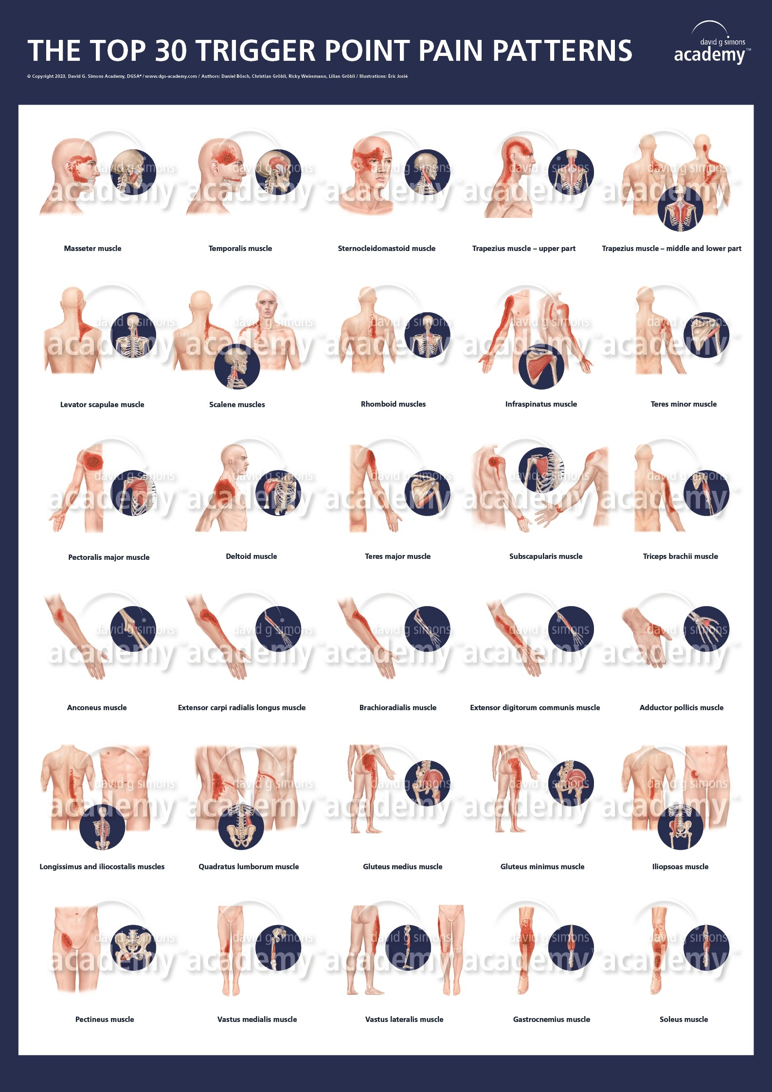 Finally Available DGSA Trigger Point Pain Pattern Posters