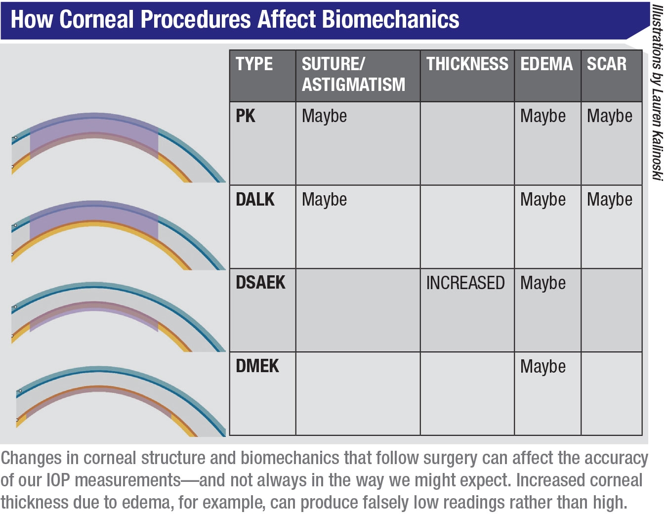 Measuring Postop IOP Don t Be Fooled