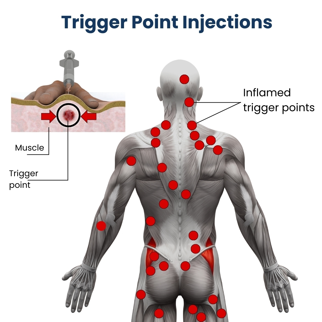 Trigger Point Injections Specialists In NYC